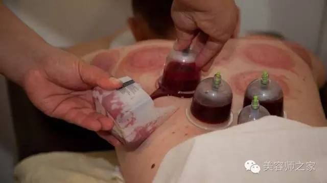干货 | 中医刺络放血疗法